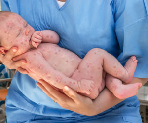 Baby with measles. (illustrative) (shutterstock)