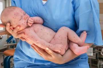 Baby with measles. (illustrative) (shutterstock)