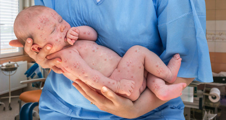 Israel battles measles outbreak as infant dies of disease