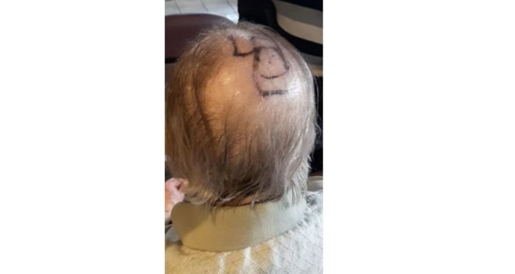 Family stunned to discover swastika painted on uncle’s head at elderly care center
