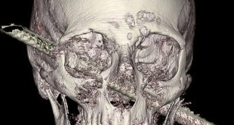 Israeli surgeons remove iron rod from man’s skull, saving life