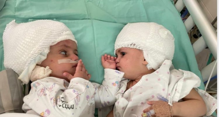 12-hour life-or-death operation a success as Israeli doctors separate conjoined twins