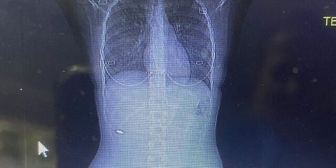 bullet X ray