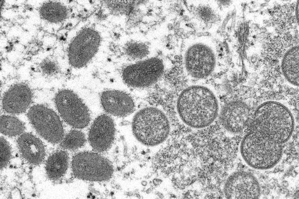 Israel confirms first case of monkeypox