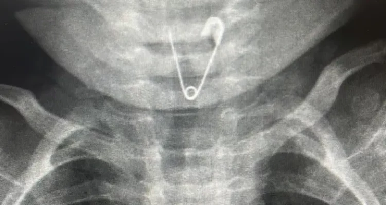 Emergency surgery saves Israeli baby who swallowed a safety pin