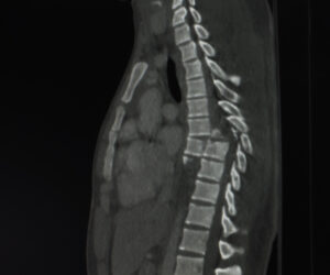 Spinal cord