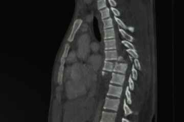 Spinal cord