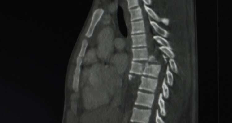 World’s first human spinal cord implant to take place in Israel