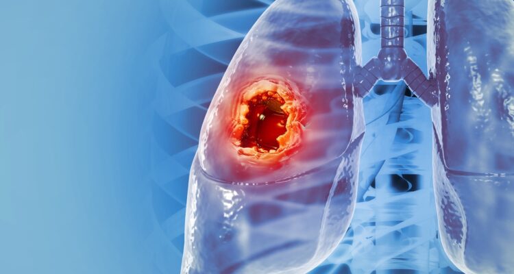 Israeli scientists identify promising new drug candidate for lung cancer