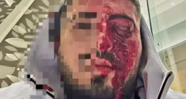 Israeli brutally attacked in Cyprus after heard speaking Hebrew; loses vision in eye