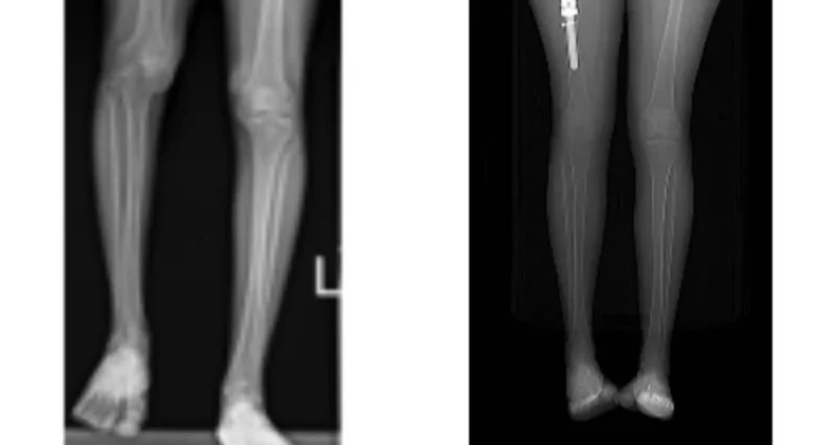 Medical breakthrough: Israeli doctors rebuild leg with 3D printing