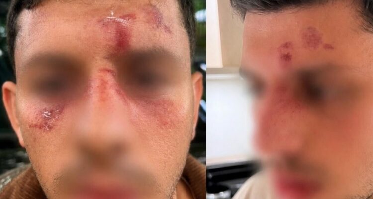 Antisemitic assault in London leaves Jew with facial injuries