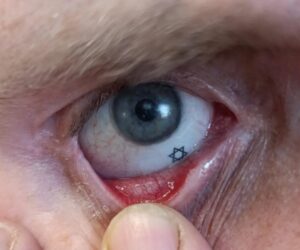 eye prosthetic