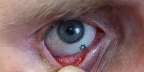 eye prosthetic