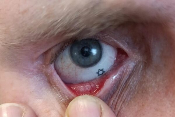 eye prosthetic