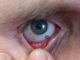 eye prosthetic